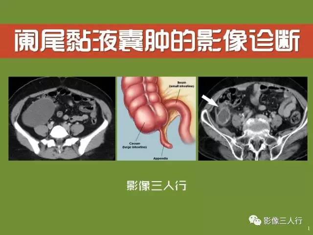 【PPT】阑尾黏液囊肿的影像诊断