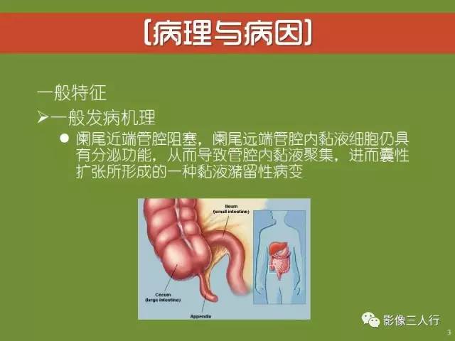 【PPT】阑尾黏液囊肿的影像诊断