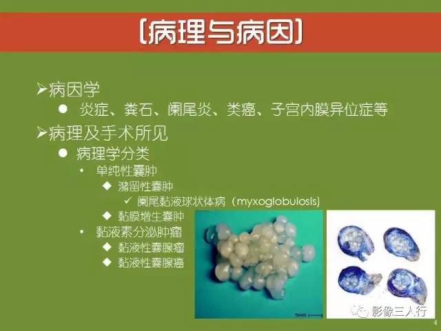 【PPT】阑尾黏液囊肿的影像诊断