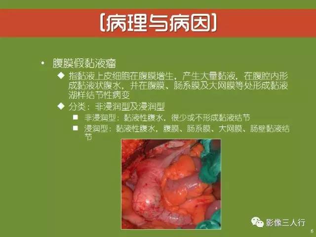 【PPT】阑尾黏液囊肿的影像诊断