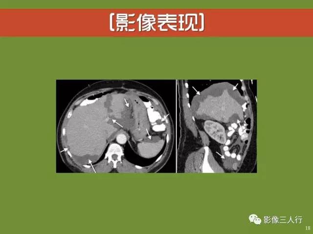 【PPT】阑尾黏液囊肿的影像诊断