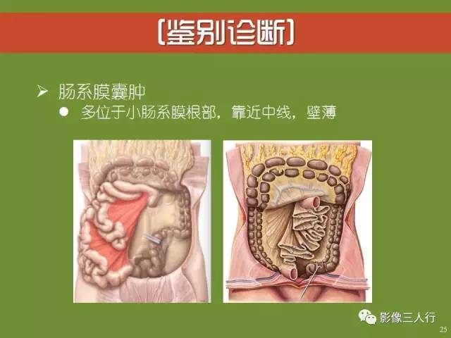 【PPT】阑尾黏液囊肿的影像诊断