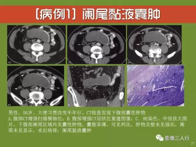 【PPT】阑尾黏液囊肿的影像诊断