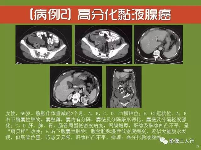 【PPT】阑尾黏液囊肿的影像诊断
