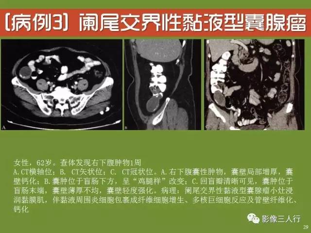 【PPT】阑尾黏液囊肿的影像诊断