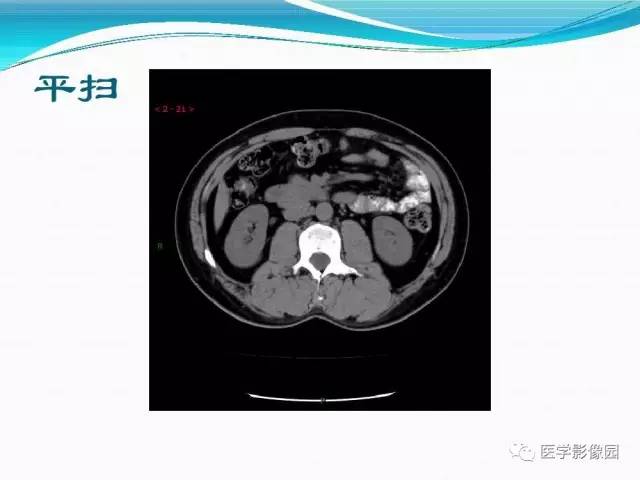 【病例】胰腺淋巴瘤1例CT影像表现