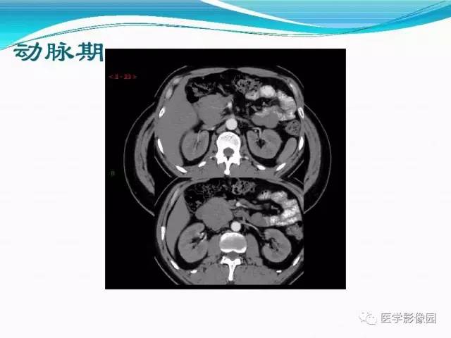【病例】胰腺淋巴瘤1例CT影像表现