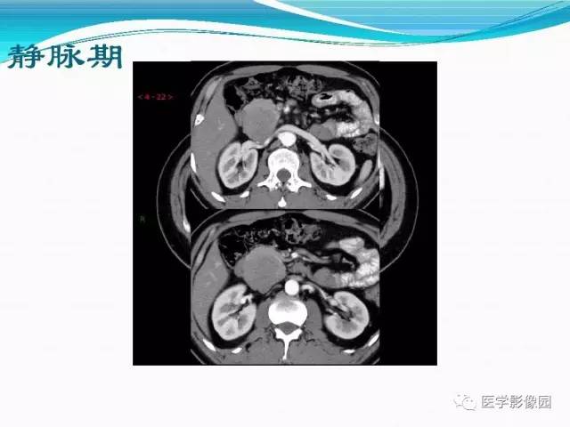 【病例】胰腺淋巴瘤1例CT影像表现