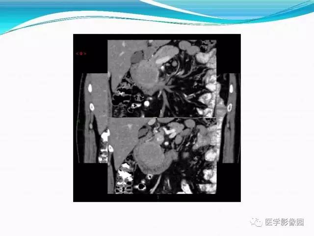 【病例】胰腺淋巴瘤1例CT影像表现