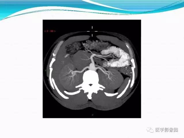 【病例】胰腺淋巴瘤1例CT影像表现