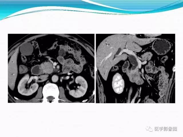 【病例】胰腺淋巴瘤1例CT影像表现