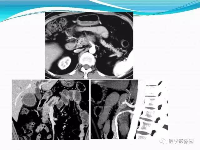 【病例】胰腺淋巴瘤1例CT影像表现