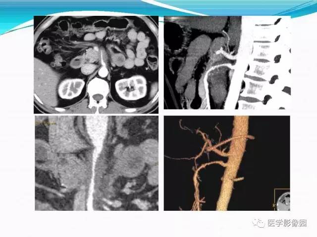 【病例】胰腺淋巴瘤1例CT影像表现