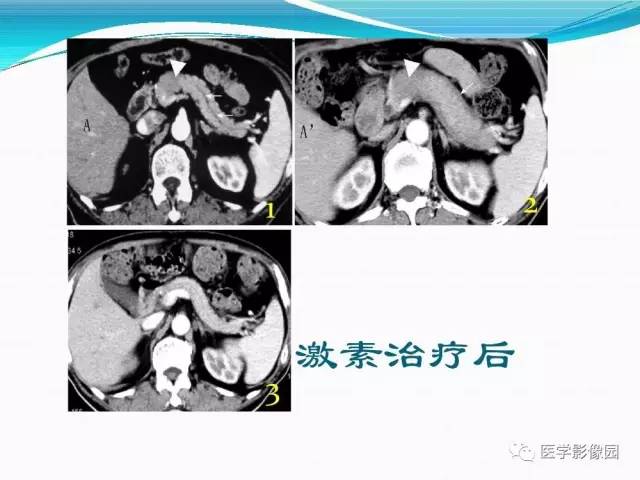 【病例】胰腺淋巴瘤1例CT影像表现