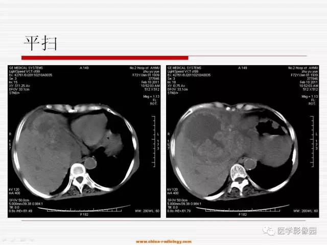 【病例】胃肠道间质瘤1例CT影像表现