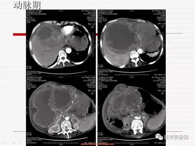 【病例】胃肠道间质瘤1例CT影像表现