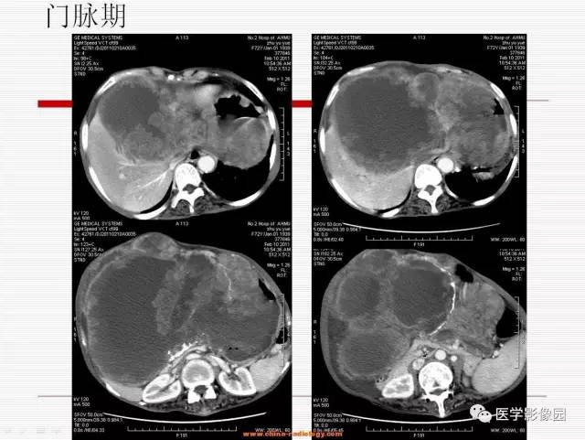 【病例】胃肠道间质瘤1例CT影像表现