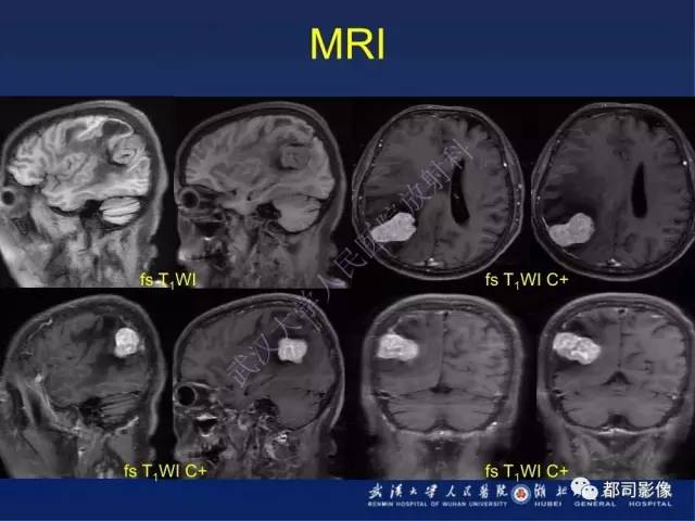 【病例】颅内孤立性纤维瘤1例MR影像诊断