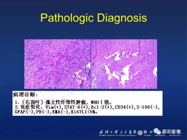 【病例】颅内孤立性纤维瘤1例MR影像诊断