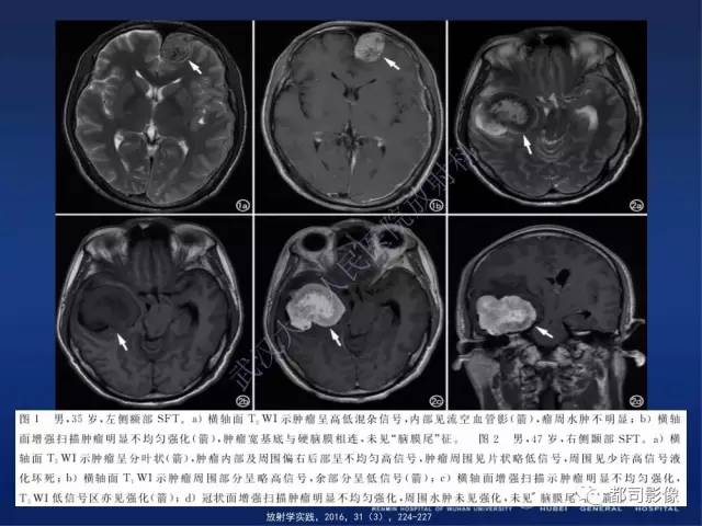 【病例】颅内孤立性纤维瘤1例MR影像诊断