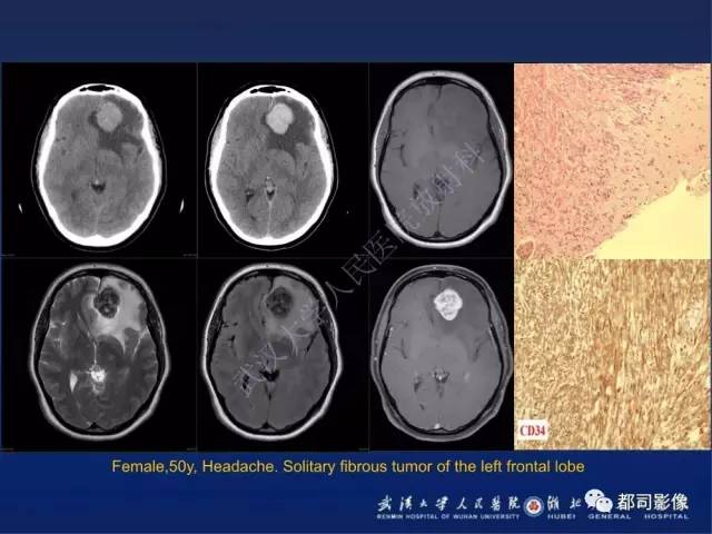 【病例】颅内孤立性纤维瘤1例MR影像诊断