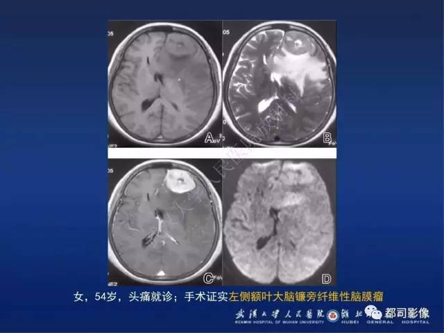 【病例】颅内孤立性纤维瘤1例MR影像诊断