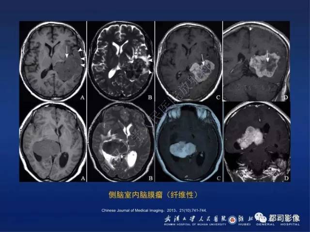 【病例】颅内孤立性纤维瘤1例MR影像诊断