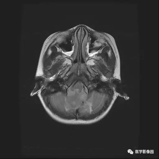 【病例】儿童四脑室室管膜瘤1例MR影像表现