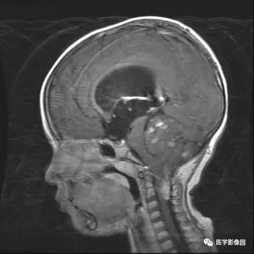 【病例】儿童四脑室室管膜瘤1例MR影像表现