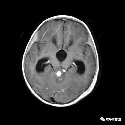 【病例】儿童四脑室室管膜瘤1例MR影像表现