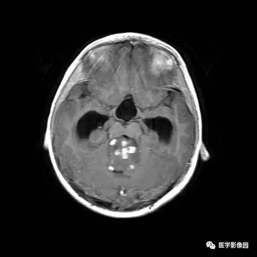 【病例】儿童四脑室室管膜瘤1例MR影像表现