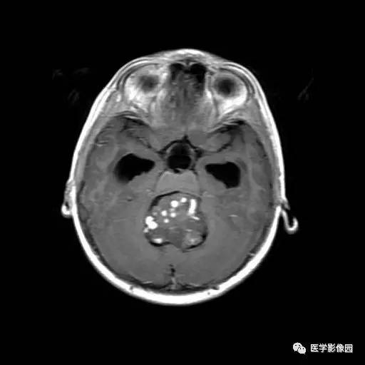 【病例】儿童四脑室室管膜瘤1例MR影像表现