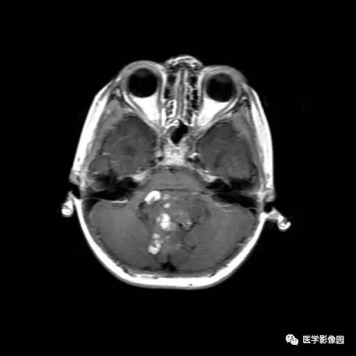【病例】儿童四脑室室管膜瘤1例MR影像表现