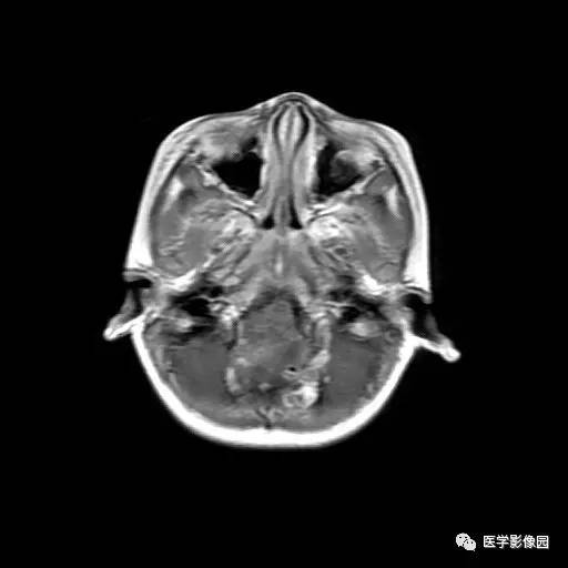 【病例】儿童四脑室室管膜瘤1例MR影像表现