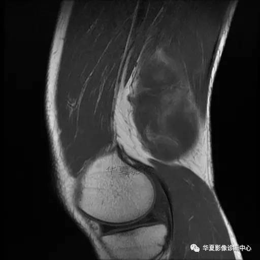 【病例】大腿脂肪肉瘤的影像分析 【病例】大腿脂肪肉瘤的影像分析