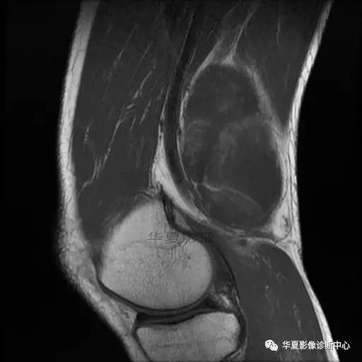 【病例】大腿脂肪肉瘤的影像分析 【病例】大腿脂肪肉瘤的影像分析