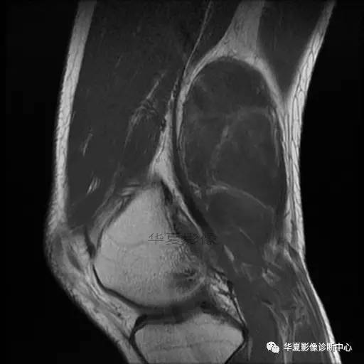 【病例】大腿脂肪肉瘤的影像分析 【病例】大腿脂肪肉瘤的影像分析