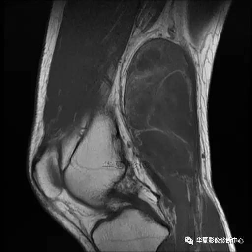 【病例】大腿脂肪肉瘤的影像分析 【病例】大腿脂肪肉瘤的影像分析