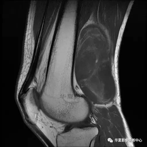 【病例】大腿脂肪肉瘤的影像分析