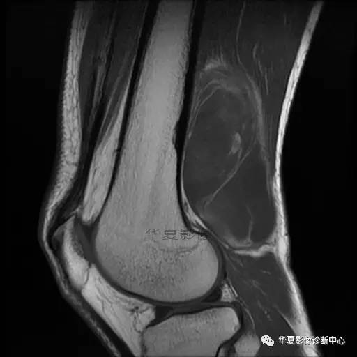 【病例】大腿脂肪肉瘤的影像分析 【病例】大腿脂肪肉瘤的影像分析
