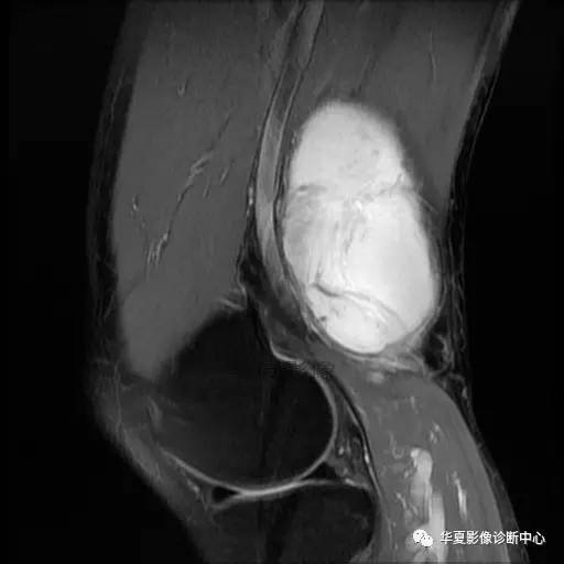 【病例】大腿脂肪肉瘤的影像分析 【病例】大腿脂肪肉瘤的影像分析