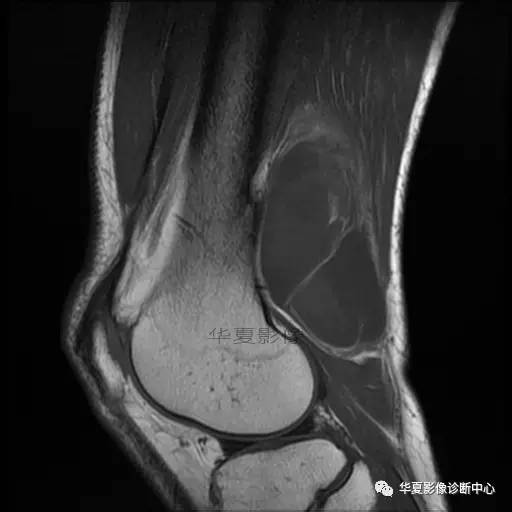 【病例】大腿脂肪肉瘤的影像分析 【病例】大腿脂肪肉瘤的影像分析