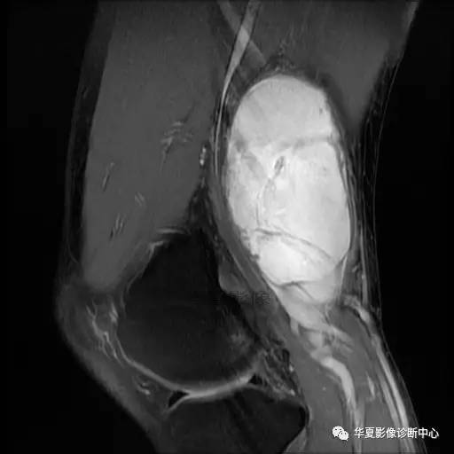 【病例】大腿脂肪肉瘤的影像分析 【病例】大腿脂肪肉瘤的影像分析