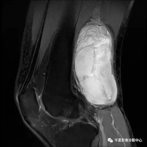 【病例】大腿脂肪肉瘤的影像分析 【病例】大腿脂肪肉瘤的影像分析