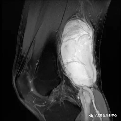 【病例】大腿脂肪肉瘤的影像分析 【病例】大腿脂肪肉瘤的影像分析