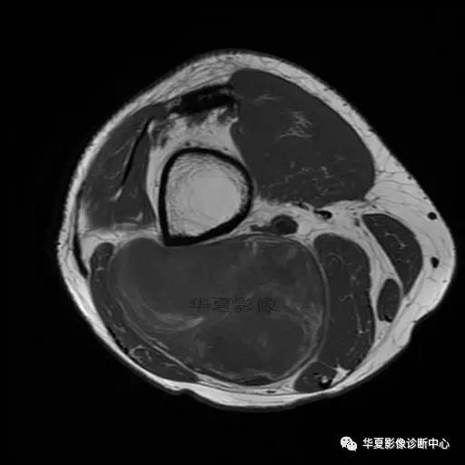 【病例】大腿脂肪肉瘤的影像分析 【病例】大腿脂肪肉瘤的影像分析