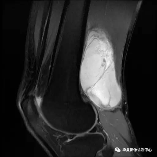 【病例】大腿脂肪肉瘤的影像分析 【病例】大腿脂肪肉瘤的影像分析