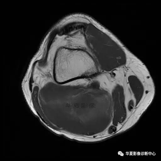 【病例】大腿脂肪肉瘤的影像分析 【病例】大腿脂肪肉瘤的影像分析