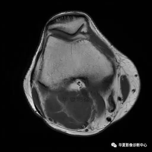 【病例】大腿脂肪肉瘤的影像分析 【病例】大腿脂肪肉瘤的影像分析