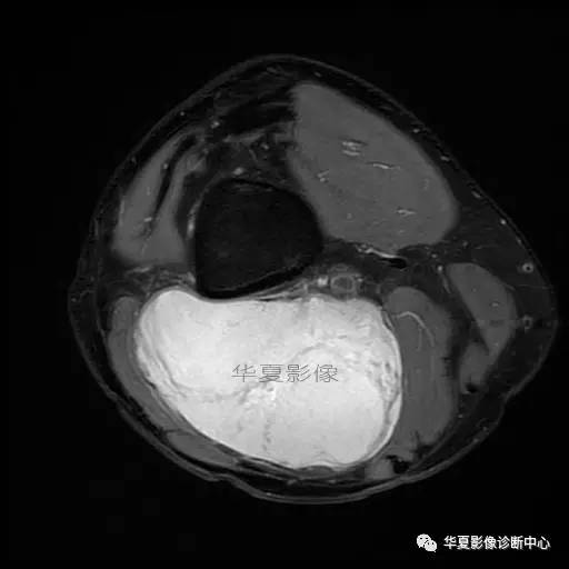 【病例】大腿脂肪肉瘤的影像分析 【病例】大腿脂肪肉瘤的影像分析